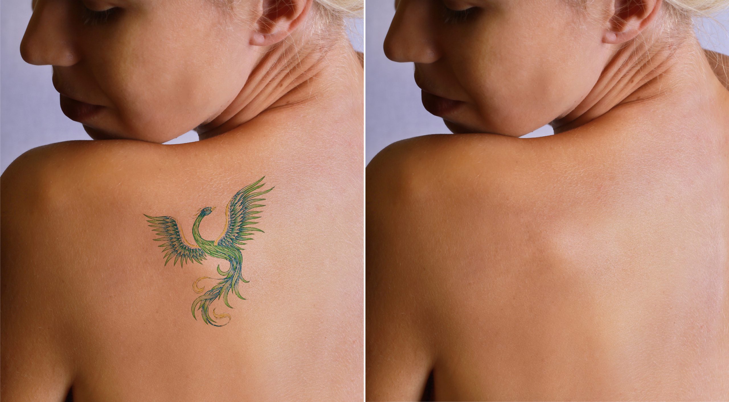 5 Signs That Tell You That it's Time to Get a Tattoo Removed