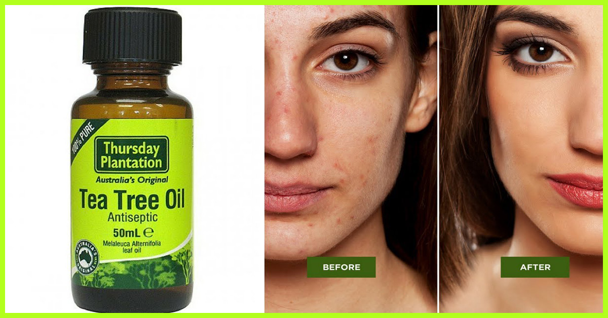 How to Use Tea Tree Oil for Acne Treatment Today