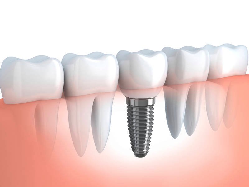 What Are the Signs of Dental Implant Failure